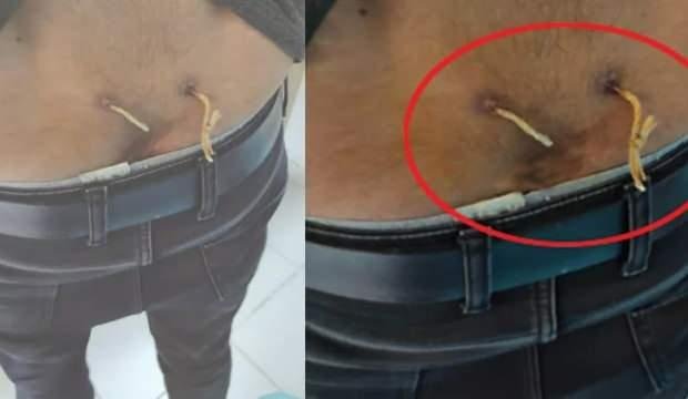 Akıllara zarar sözde tedavi yöntemi! Beline delik açıp çamaşır ipi geçirdiler…