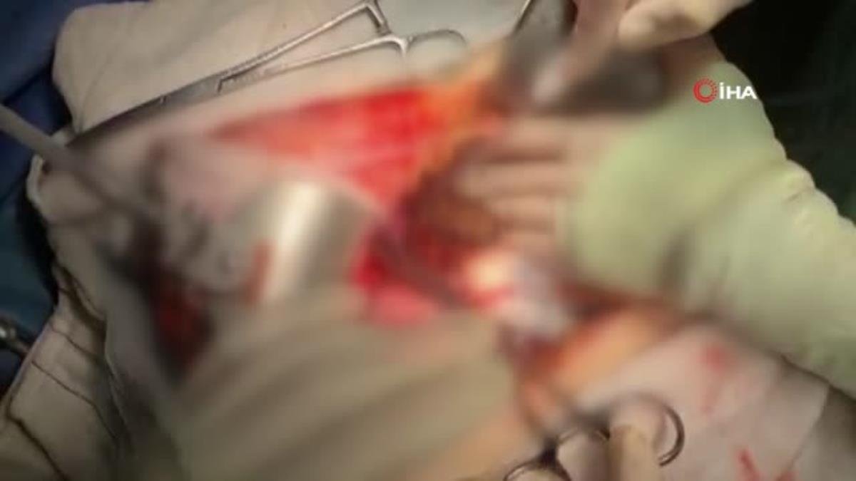 Almanya’da 4 ayrı ameliyat önerilen kanser hastası Türkiye’de tek ameliyat ile şifa buldu