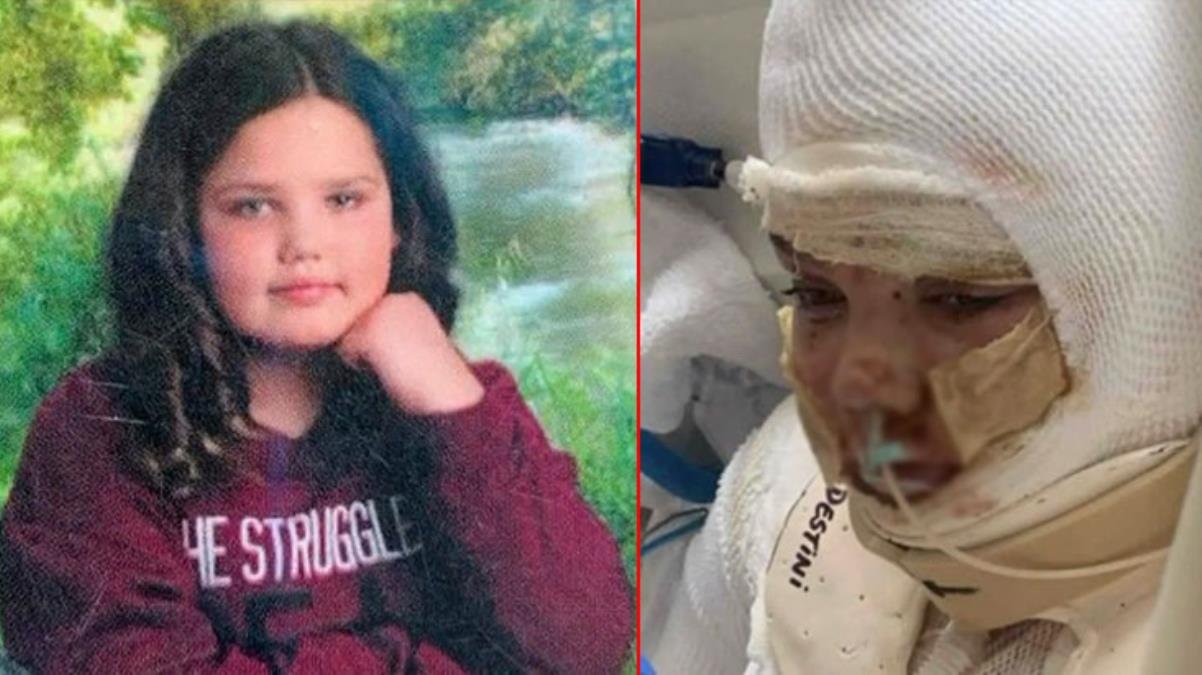 Korkunç olay! Tiktok’taki alkolle yazı yazma akımına katılan 13 yaşındaki kız çocuğu, alevler içerisinde kaldı