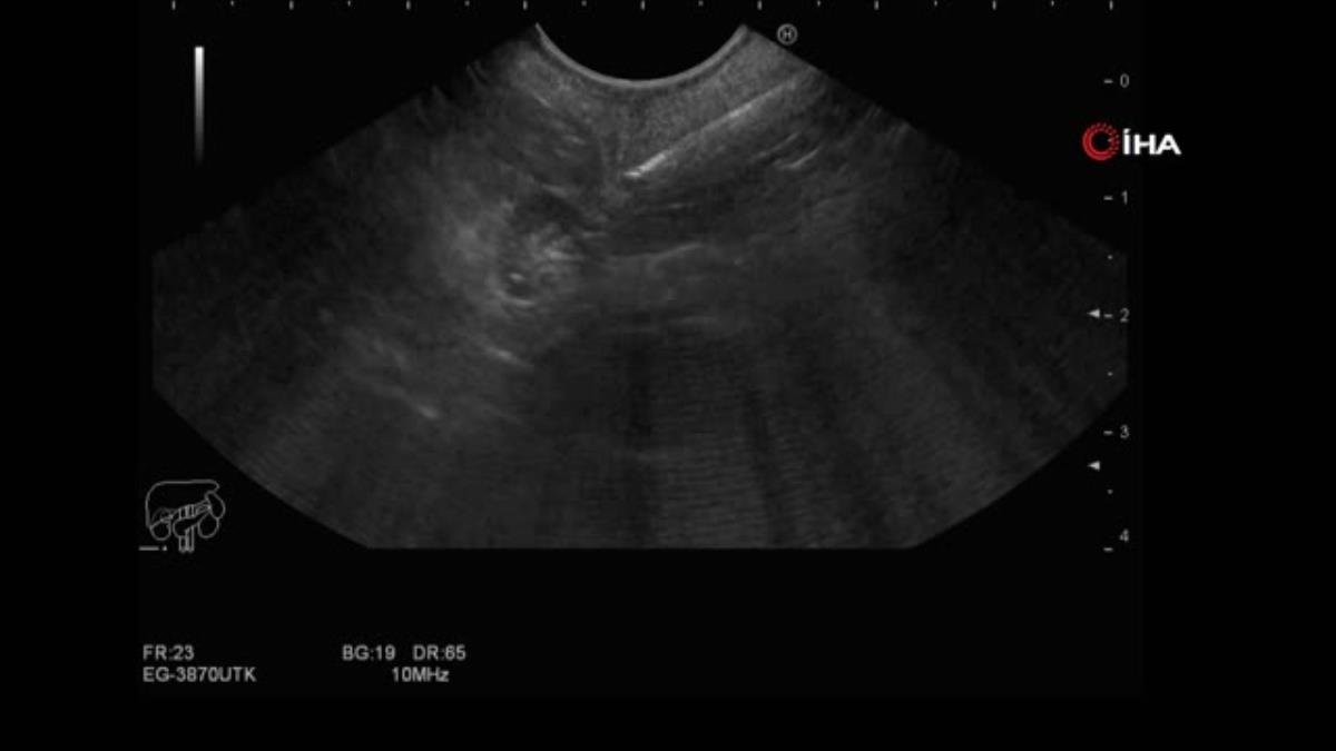Türkiye’de 35’inci, bölgede ilk olan vakayı Mersin’de başarıyla gerçekleştirdiler