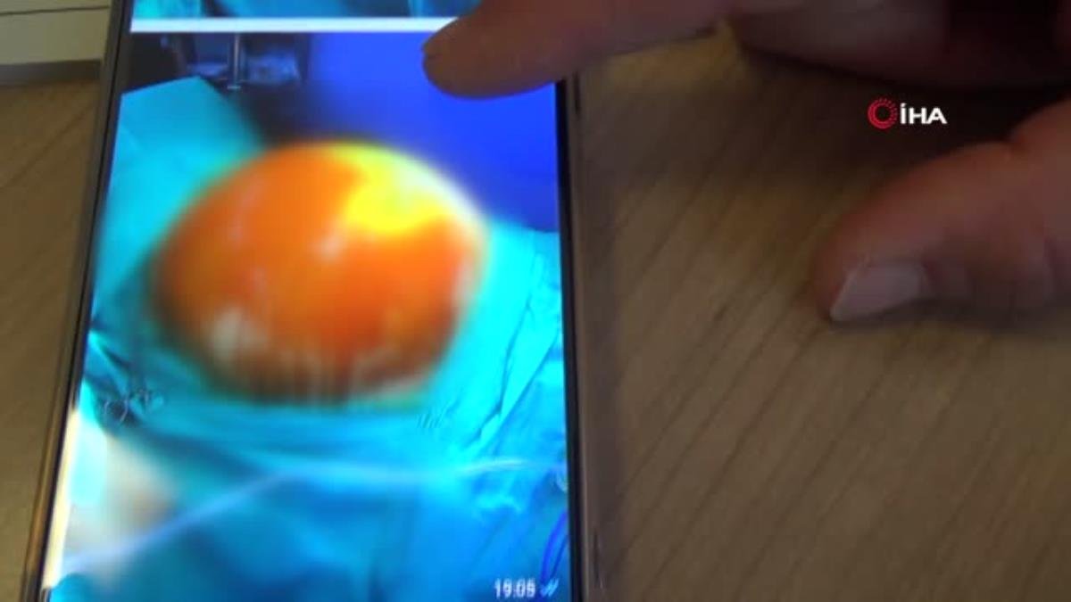 Safra kesesi şikayeti ile geldi, karnından 15 kilonun üzerinde tümör çıktı