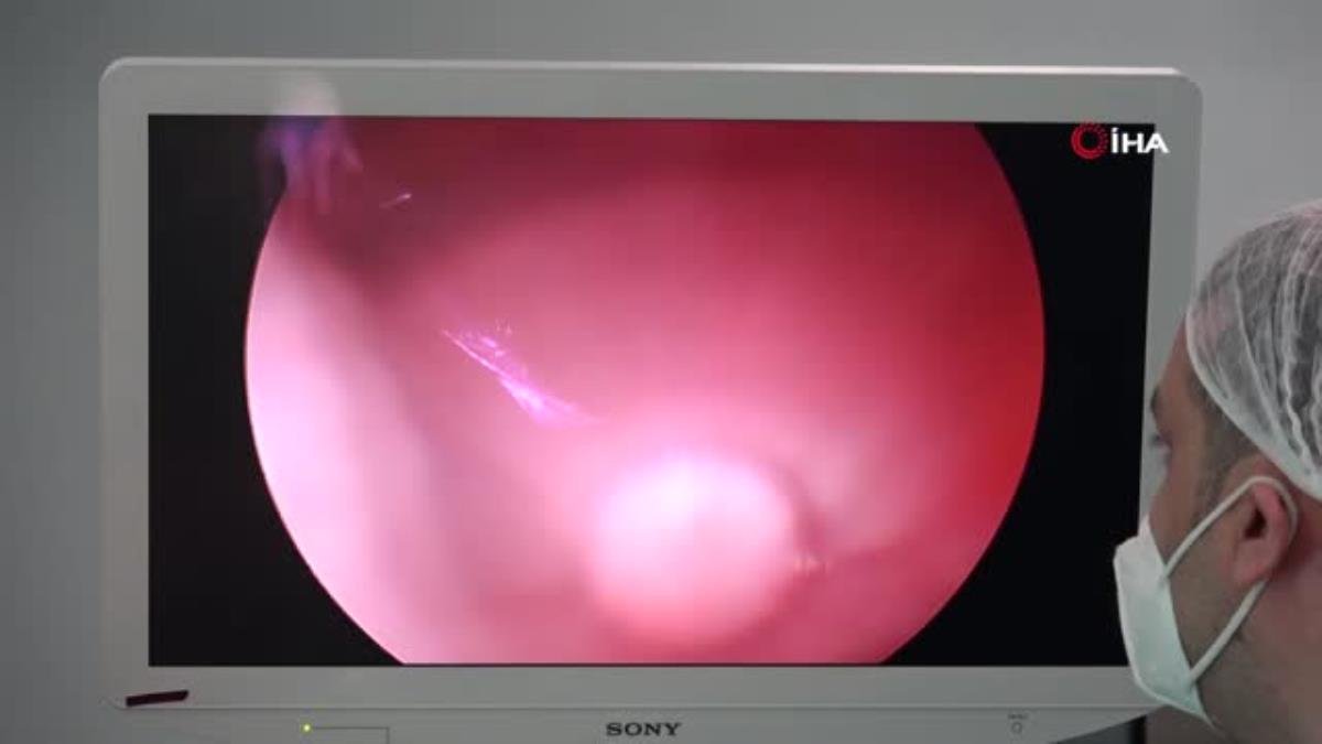 Sancaktepe’de Pektus Farkındalık Haftasına dikkat çekmek için 5 hasta ameliyat edildi