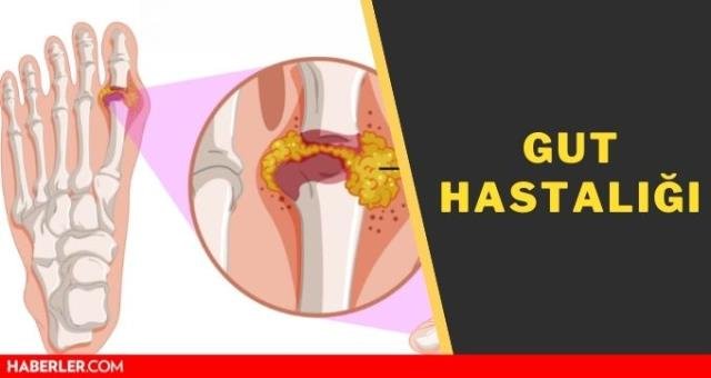 Gut hastalığı! Gut hastalığı nedir? Gut hastalığı belirtileri nedir, neden olur, ne yemeli?
