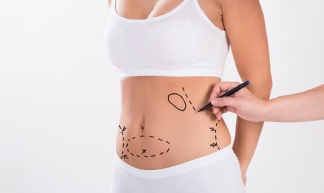 Karın germe ameliyatı nedir? Karın germe ameliyatı nasıl yapılır, riski nedir?