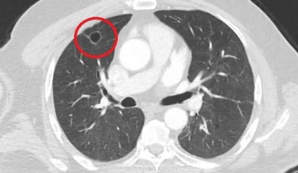Koronavirüsün akciğer kanserini taklit ettiği ortaya çıktı