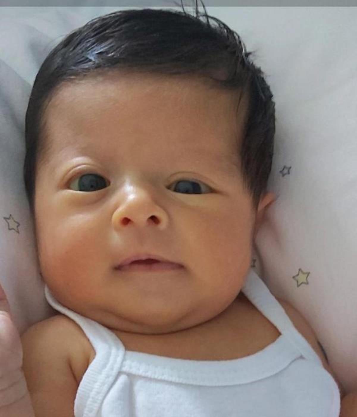 2 aylık Lina’nın kafatası kemiklerindeki deformasyon ameliyatla düzeltildi