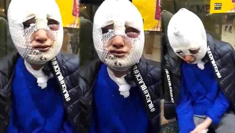 Eski kız arkadaşına kızgın yağ döken ve 3 ay sonra tahliye olan zanlı hakkında yakalama kararı