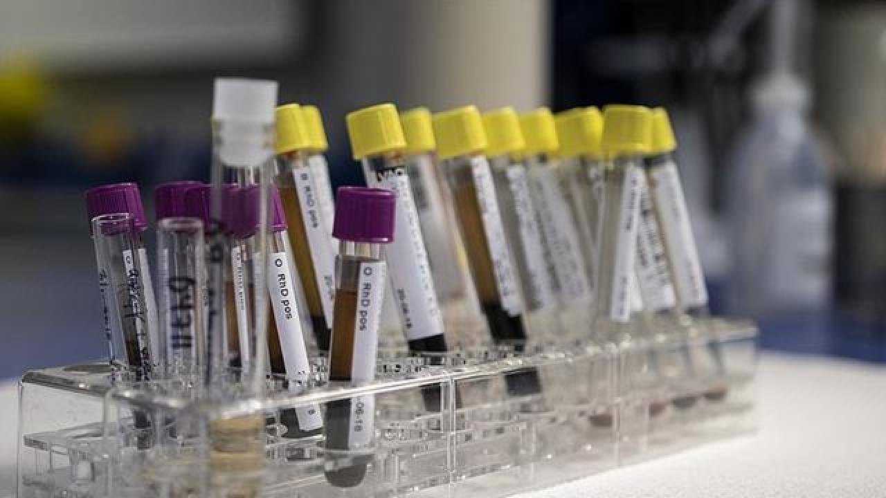 DSÖ: İngiltere’de nedeni belirsiz 74 hepatit vakası tespit edildi