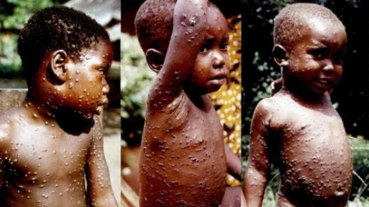 DÖS: Maymun çiçeği vakaları artabilir