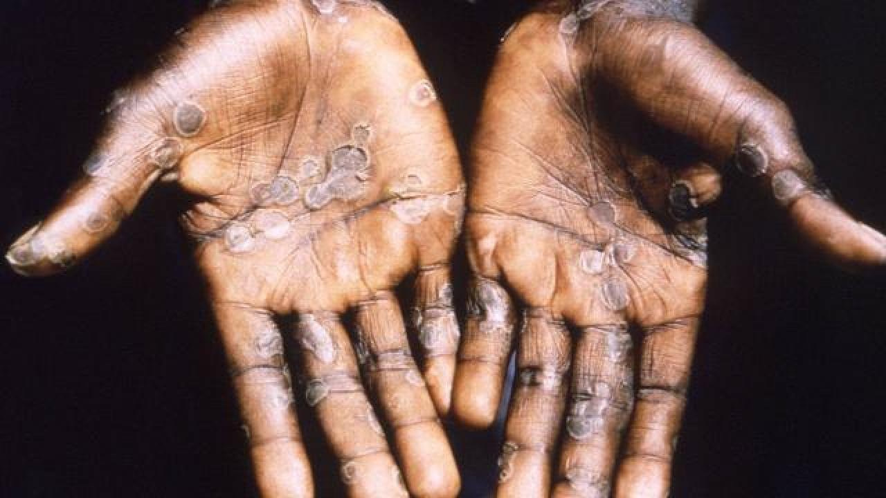 Maymun çiçeği vakası o ülkeye de sıçradı