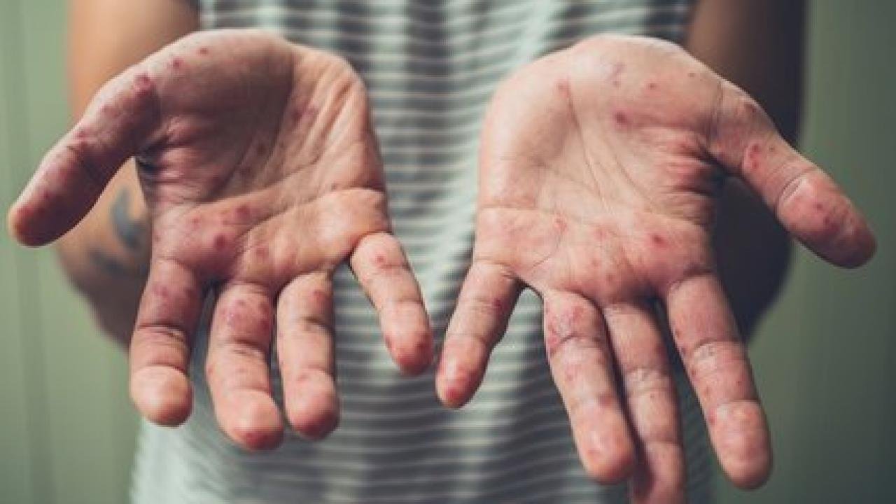 Meksika’da ilk maymun çiçeği vakası tespit edildi