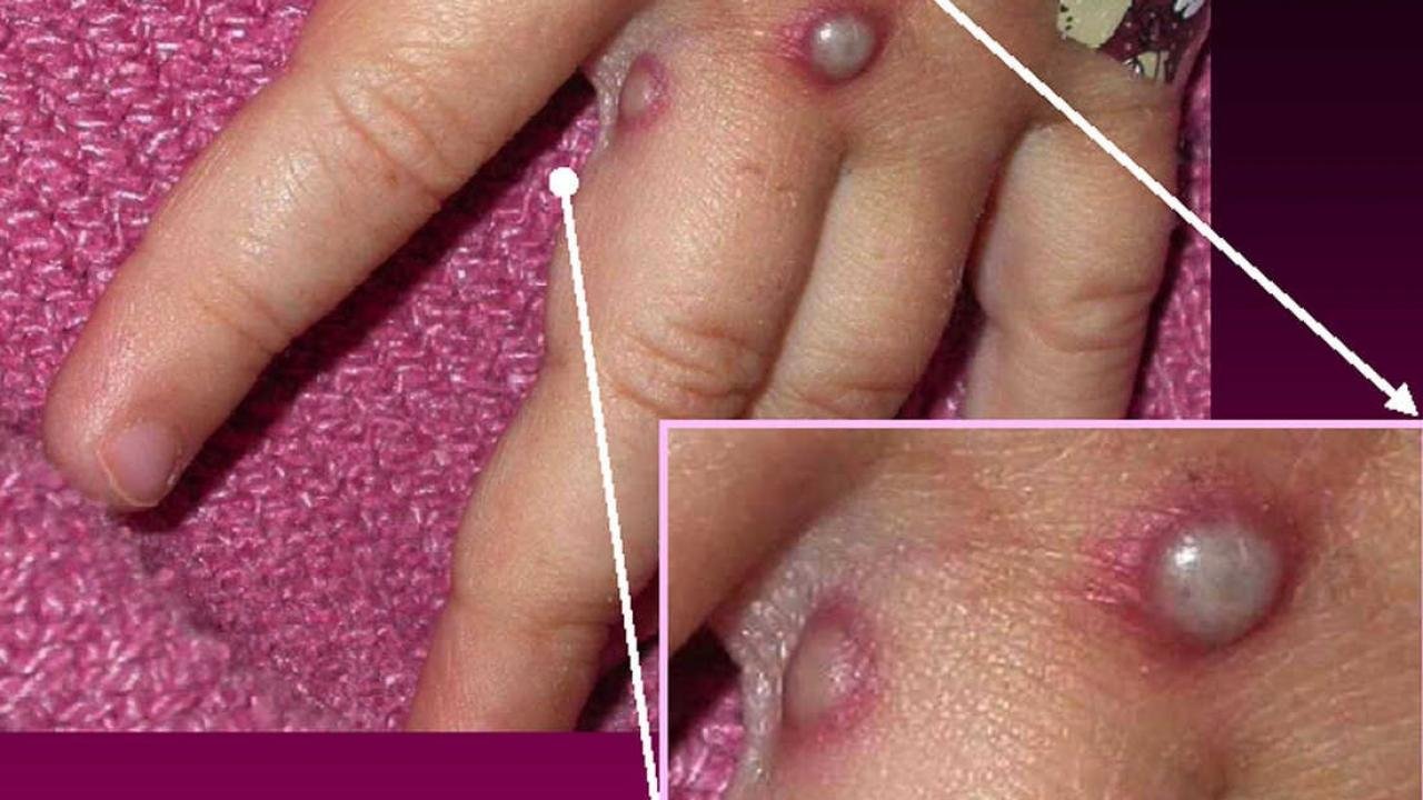 Son dakika haberi: DSÖ’den maymun çiçeği virüsü için korkutan açıklama