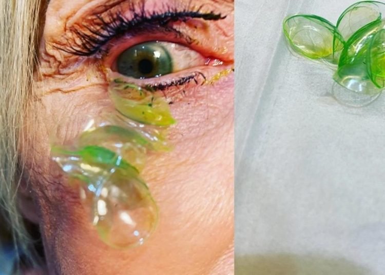 ABD’de hastanın gözünden 23 kontakt lens çıkarıldı