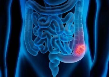 Kolon Kanseri Belirti Vermeden İlerleyebilir, Erken Teşhisle Sağlığınızı Koruyun